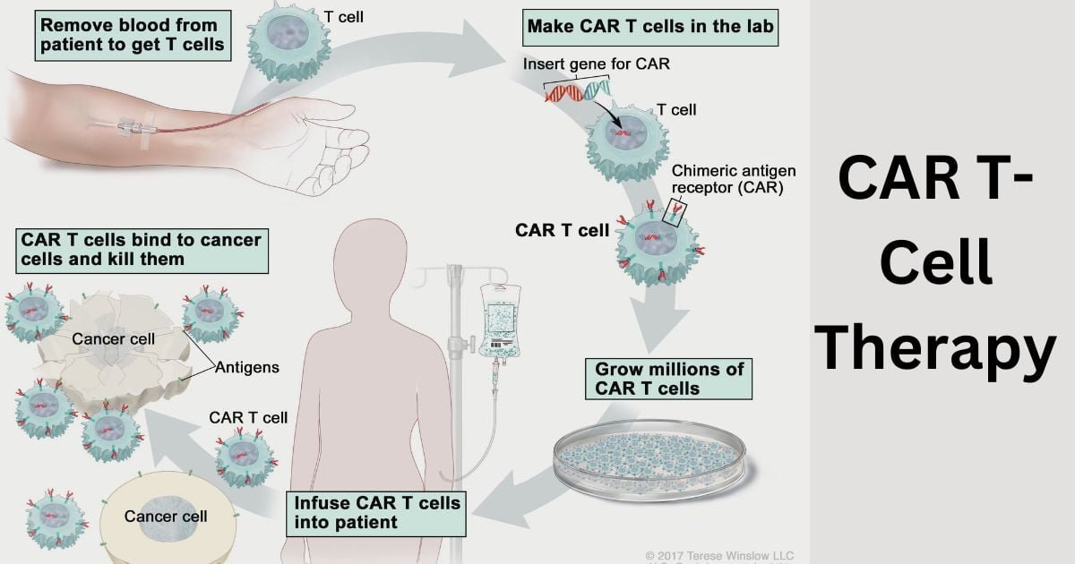 CAR-T Cell Therapy